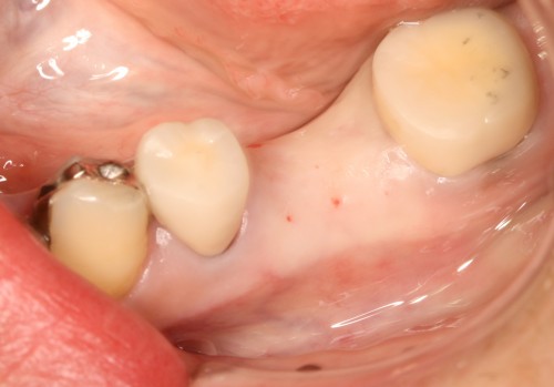 石川2　埋入直前